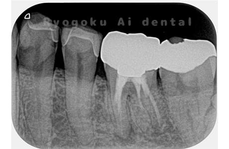 慢性根尖性歯周炎