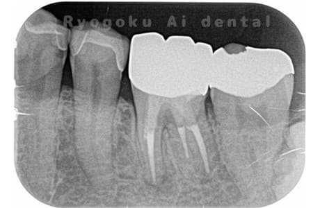 マイクロエンド術後