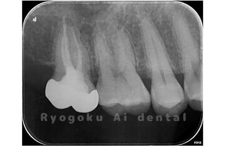 マイクロエンド術後