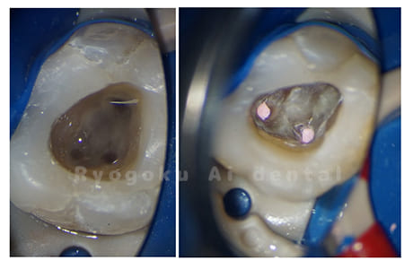 マイクロエンド術中