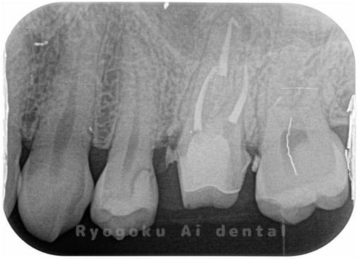 マイクロエンド術後
