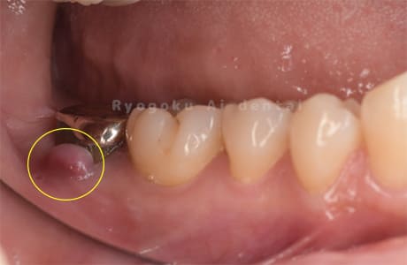 慢性根尖性歯周炎術前