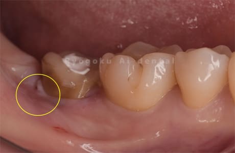 慢性根尖性歯周炎術後