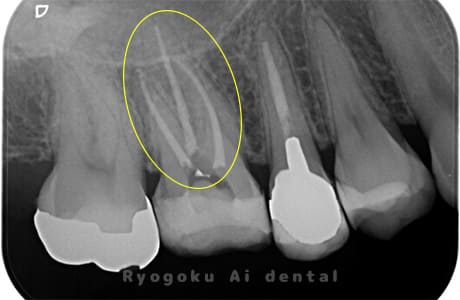 慢性根尖性歯周炎術後