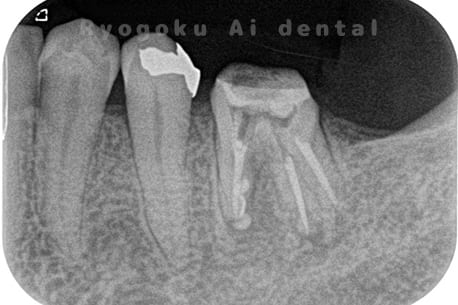 慢性根尖性歯周炎術後