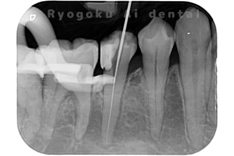 マイクロエンド術中