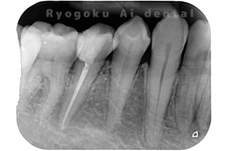 マイクロエンド術後