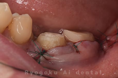 マイクロエンド並びに歯周再生療法術後縫合