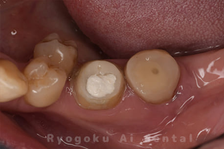 マイクロエンド並びに歯周再生療法手術後