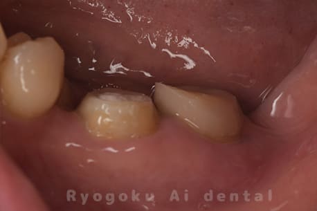 マイクロエンド並びに歯周再生療法手術後