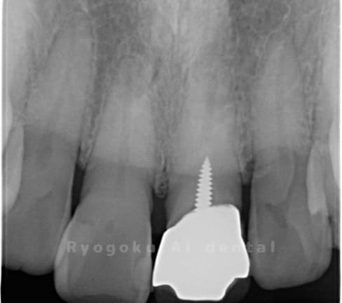 慢性根尖性歯周炎術前