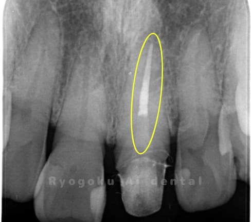 慢性根尖性歯周炎術後