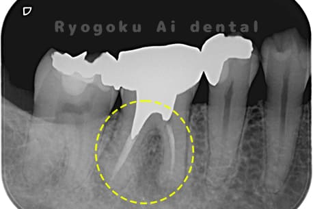 慢性根尖性歯周炎レントゲン写真術前