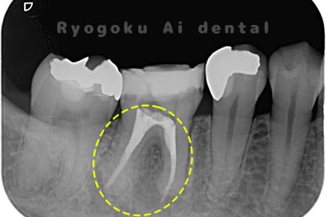 慢性根尖性歯周炎レントゲン写真術後