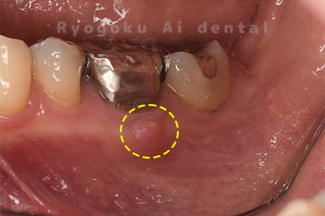 慢性根尖性歯周炎術前