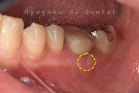 慢性根尖性歯周炎術後