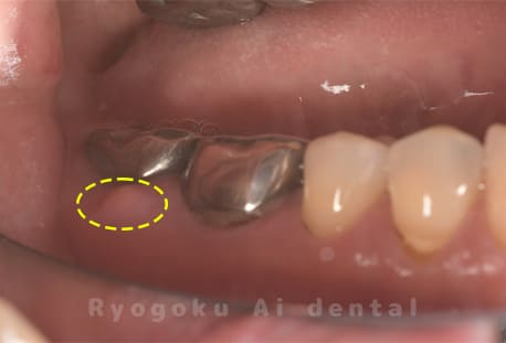 慢性根尖性歯周炎レントゲン写真術前