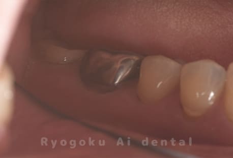 慢性根尖性歯周炎レントゲン写真術後