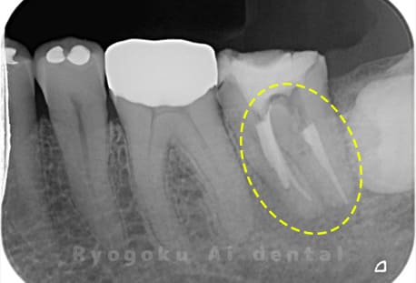 慢性根尖性歯周炎術前