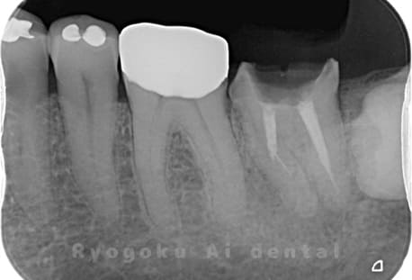 慢性根尖性歯周炎術後