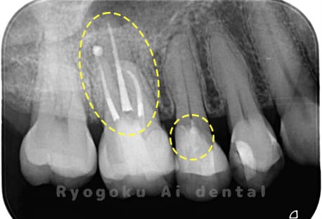 16マイクロエンド治療、15断髄治療