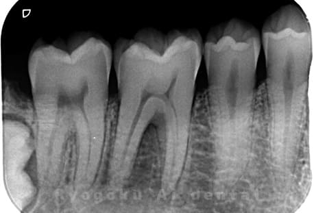 急性化膿性歯髄炎