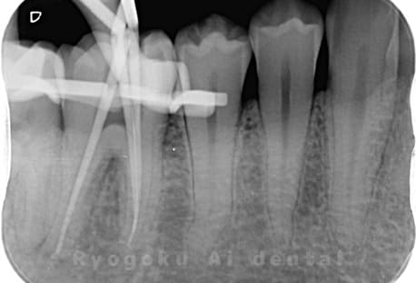 急性化膿性歯髄炎のマイクロエンド治療中