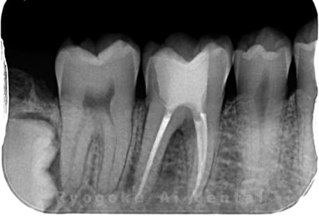 マイクロエンド治療後