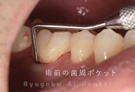 術前歯周ポケット