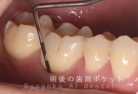 術後歯周ポケット