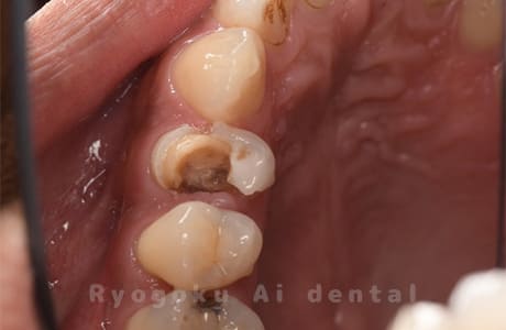 慢性根尖性歯周炎レントゲン写真術前