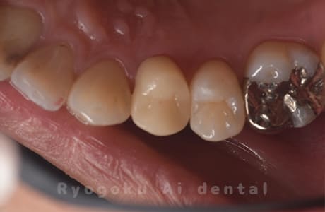 慢性根尖性歯周炎レントゲン写真術後