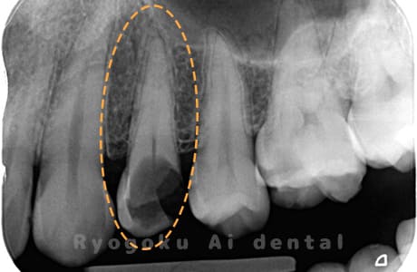 慢性根尖性歯周炎術前
