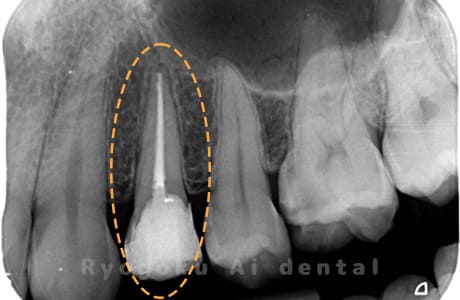 慢性根尖性歯周炎術後
