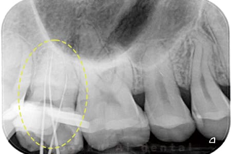 マイクロエンド術中