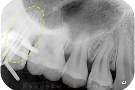 マイクロエンド術中