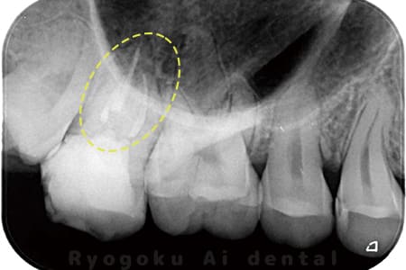 マイクロエンド術後