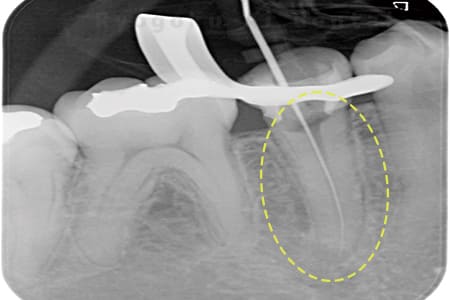 マイクロエンド術中
