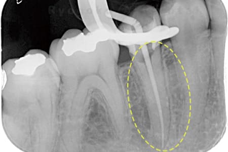 マイクロエンド術中