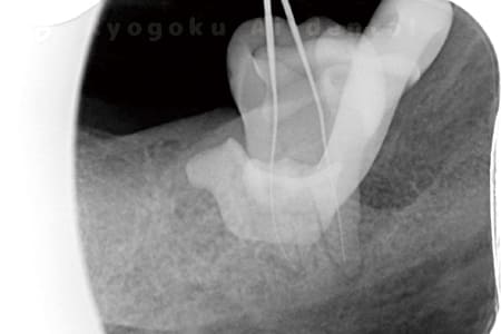 マイクロエンド術中