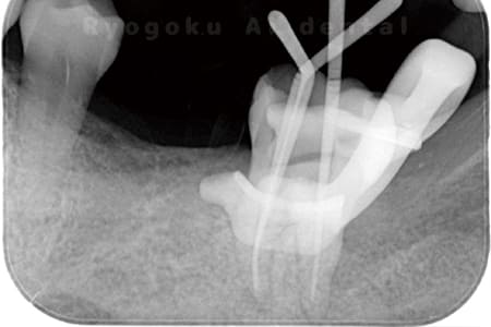 マイクロエンド術中