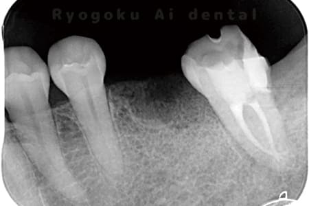 マイクロエンド術後