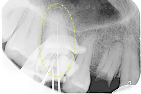 マイクロエンド術中