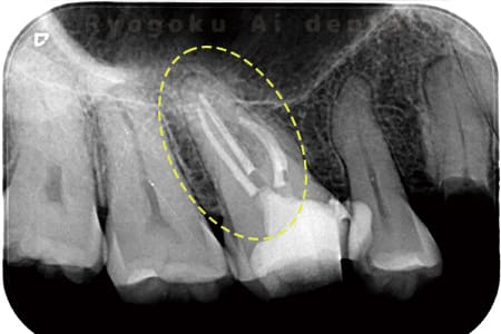 マイクロエンド術後