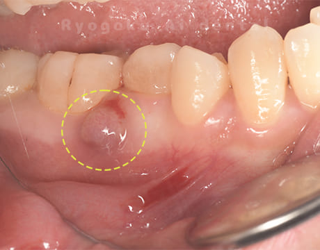 慢性根尖性歯周炎術前