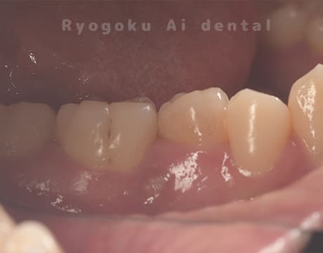 慢性根尖性歯周炎術後