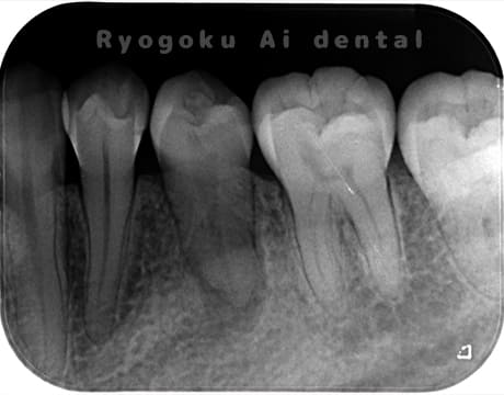 慢性根尖性歯周炎レントゲン写真術前