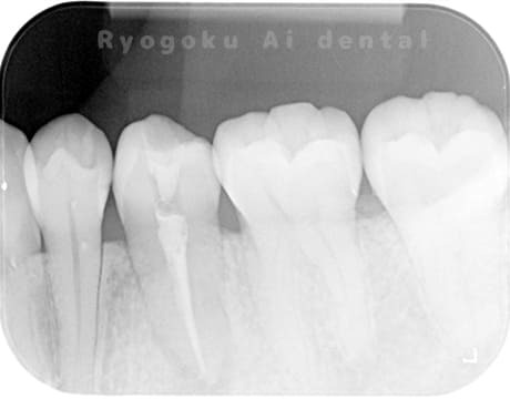 慢性根尖性歯周炎レントゲン写真術後