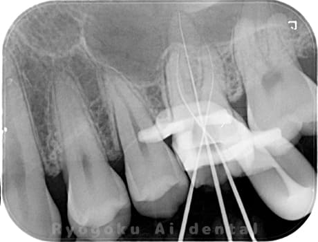 マイクロエンド術中