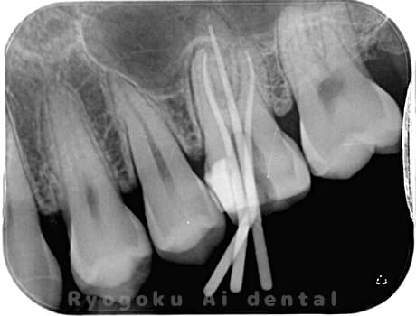 マイクロエンド術中